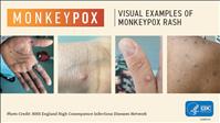 Monkeypox arrives in Lake County