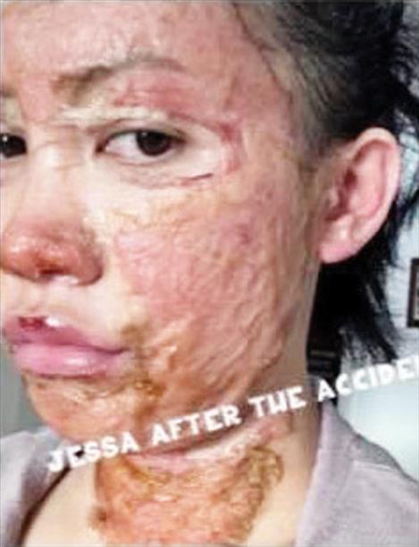 Jessa Berdan after accident
